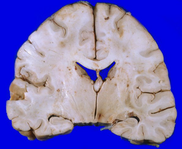 1C3 Astrocytoma, diffuse (Case 1) A 7