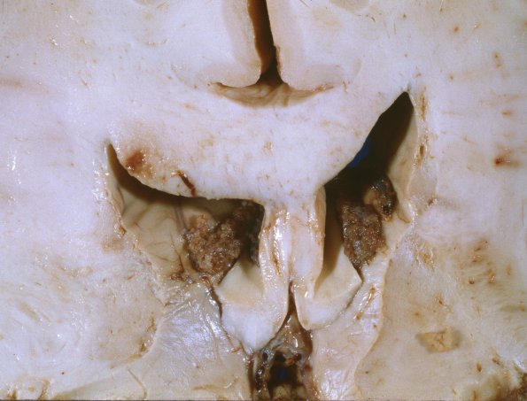 1C4 Astrocytoma, diffuse (Case 1) A 2