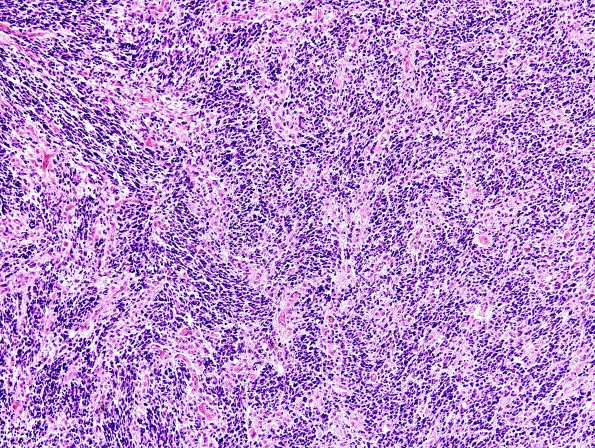 1C6 Gliomatosis Cerebri (Case 1), focal GBM H&E 3