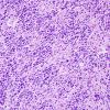 1C7 Astrocytoma, diffuse (Case 1) H&E block L 1