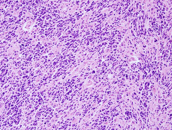 1C7 Astrocytoma, diffuse (Case 1) H&E block L 1