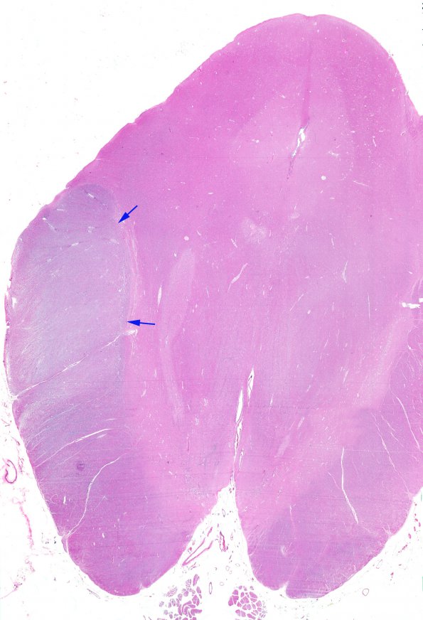 1D1 Astrocytoma, diffuse (Case 1) H&E midbrain WM copy