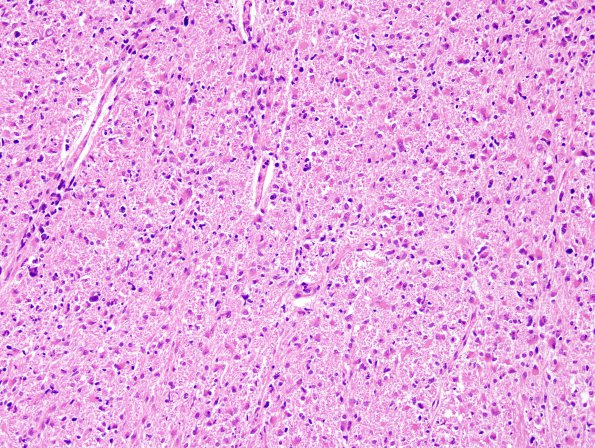 1D2 Astrocytoma, diffuse (Case 1) H&E midbrain 2