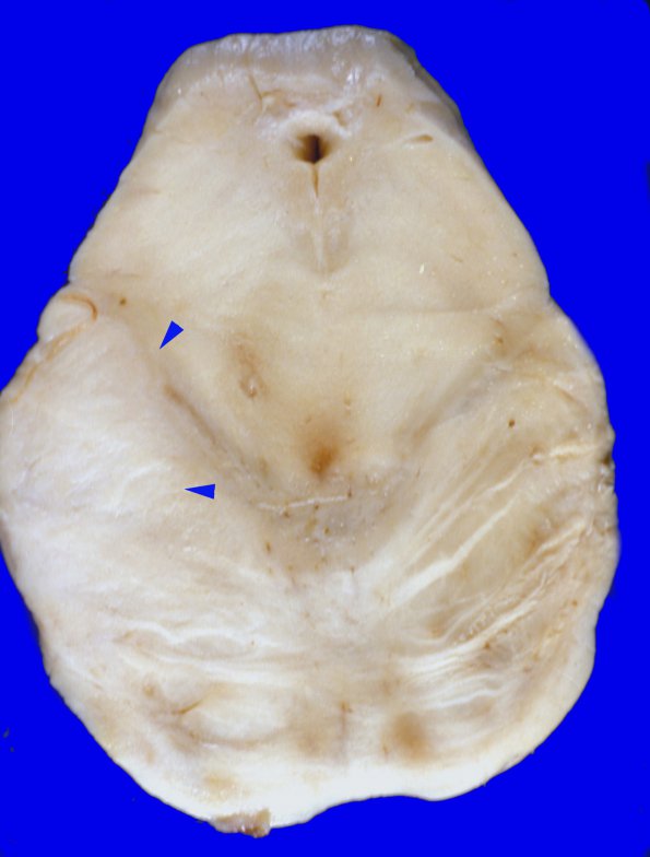 1E1 Gliomatosis Cerebri (Case 1),focal GBM gross 7 copy