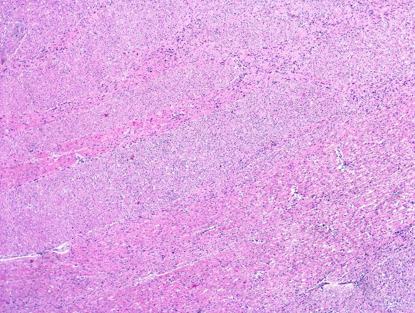 1E2 Astrocytoma, diffuse (Case 1) Pons H&E 3