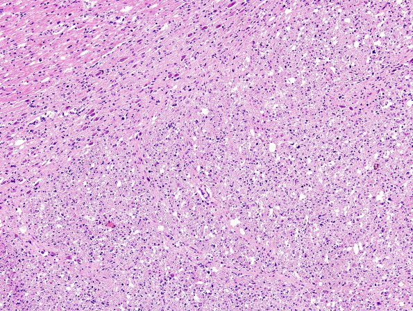 1E3 Astrocytoma, diffuse (Case 1) Pons H&E 1