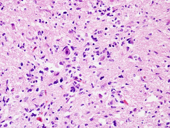 1E4 Astrocytoma, diffuse (Case 1) Pons H&E 4