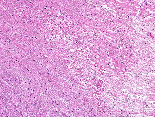 1F3 Astrocytoma, diffuse (Case 1) Pons H&E (infarct area) 1