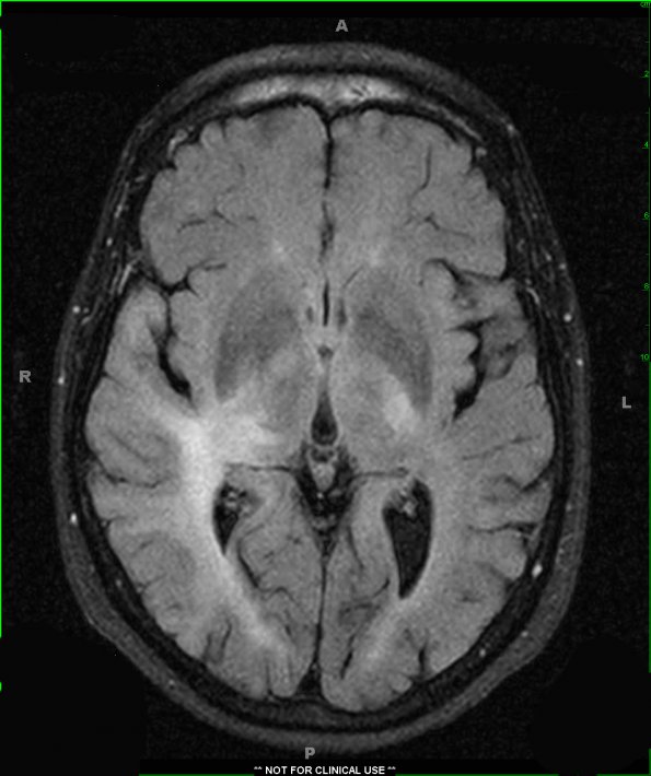 2A1 Gliomatosis (Case 2) FLAIR - Copy