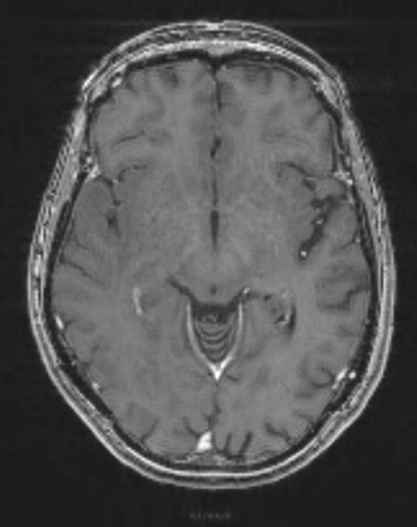 2A2 Gliomatosis (Case 2) T1 W - Copy