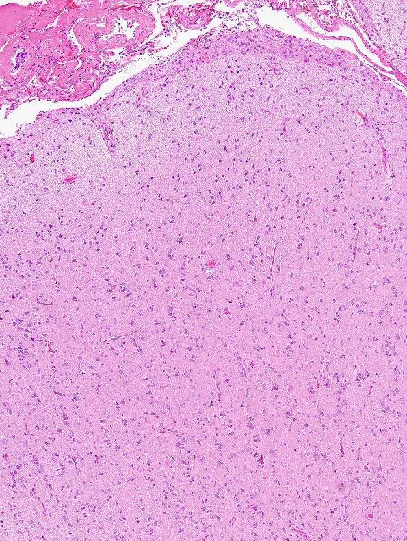 2B1 Gliomatosis (Case 2) H&E 1