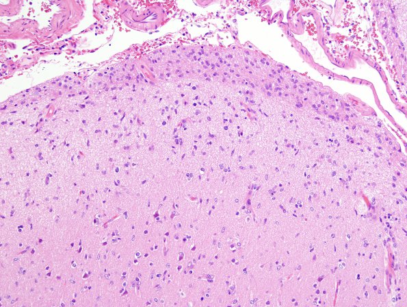 2B2 Gliomatosis (Case 2) H&E 8