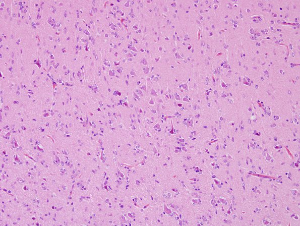 2B3 Gliomatosis (Case 2) H&E 3