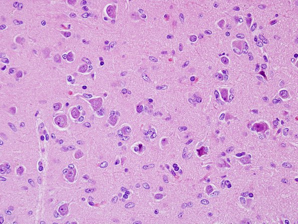 2B4 Gliomatosis (Case 2) H&E 5