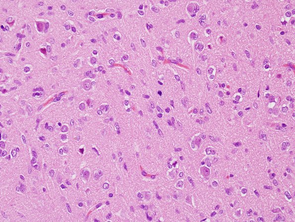 2B5 Gliomatosis (Case 2) H&E 7