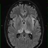 3A1 Gliomatosis cerebri (Case 3) T2 FLAIR 2 - Copy