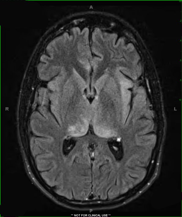 3A1 Gliomatosis cerebri (Case 3) T2 FLAIR 2 - Copy