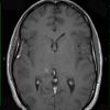 3A2 Gliomatosis cerebri (Case 3) T1 W - Copy