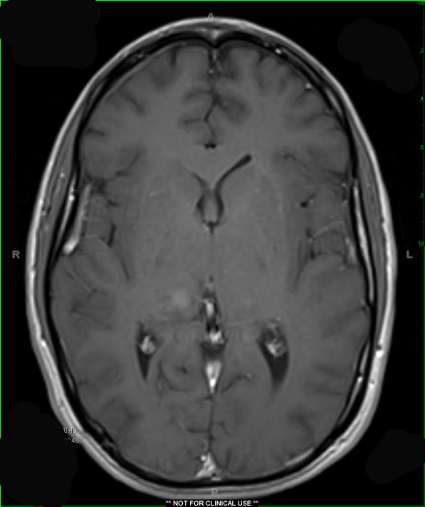 3A2 Gliomatosis cerebri (Case 3) T1 W - Copy