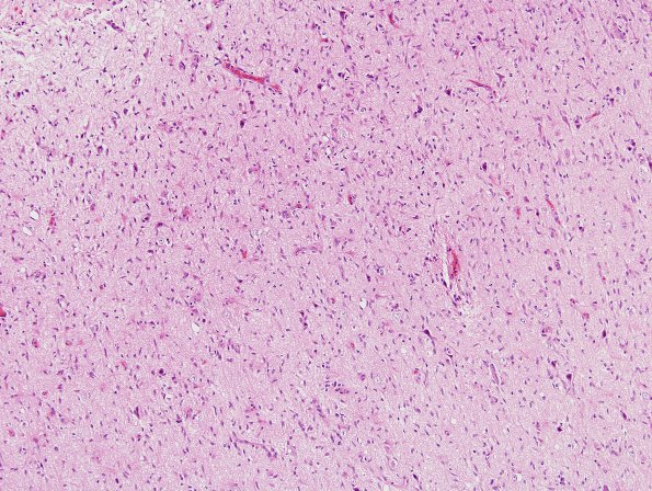 3B1 Gliomatosis cerebri (Case 3) H&E 5a