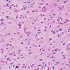 3B2 Gliomatosis cerebri (Case 3) H&E 9