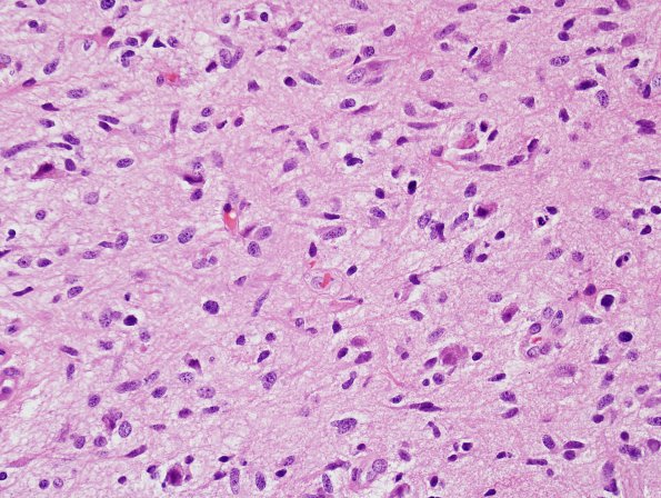 3B2 Gliomatosis cerebri (Case 3) H&E 9