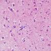 3B3 Gliomatosis cerebri (Case 3) H&E 1 copy