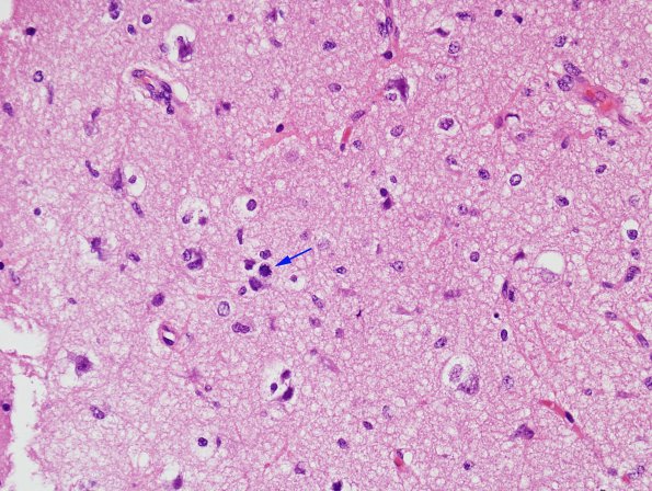 3B3 Gliomatosis cerebri (Case 3) H&E 1 copy