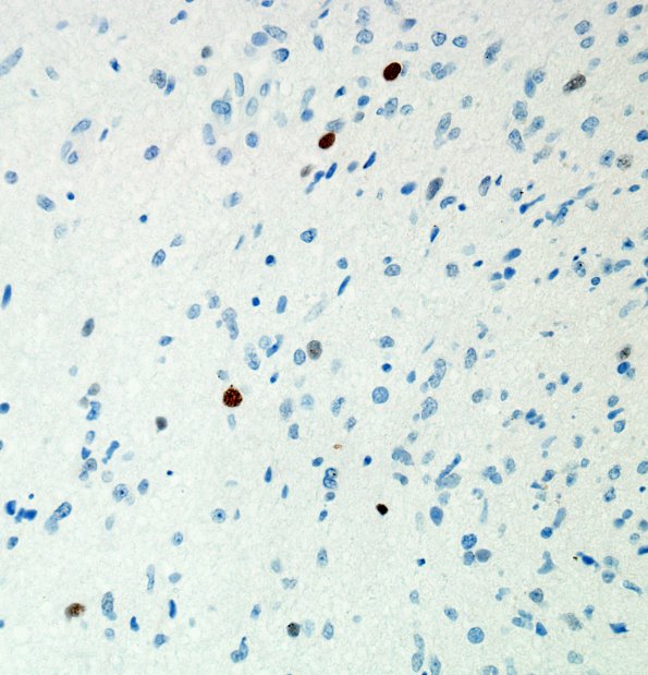 3B5 Gliomatosis cerebri (Case 3) P53 3