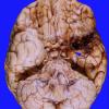 4A1 Gliomatosis cerebri, focal GBM (Case 4) base brain 2A copy