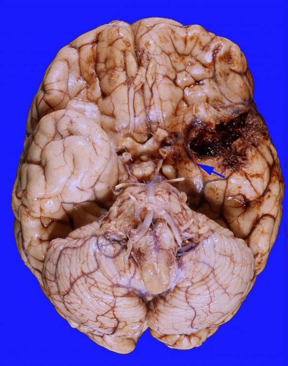 4A1 Gliomatosis cerebri, focal GBM (Case 4) base brain 2A copy