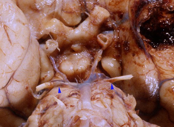 4A2 Gliomatosis cerebri, focal GBM (Case 4) base brain 2B copy