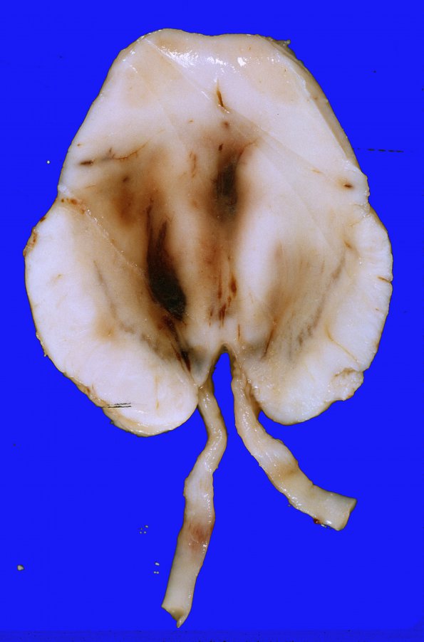 4A3 Gliomatosis cerebri & GBM (Case 4) MB