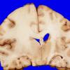 4A4 Gliomatosis cerebri, focal GBM (Case 4) 7