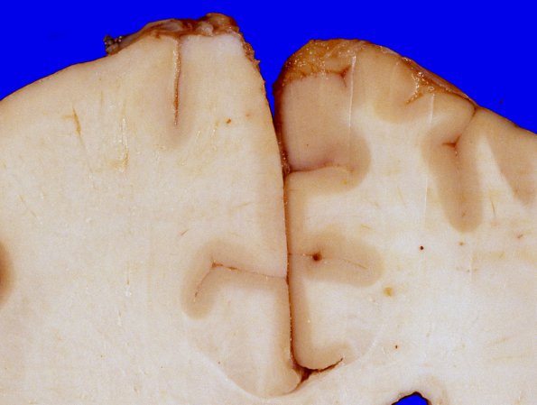 4A5 Gliomatosis cerebri, focal GBM (Case 4) 6A