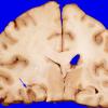 4A6 Gliomatosis cerebri, focal GBM (Case 4) 4 copy