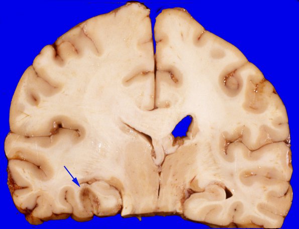 4A6 Gliomatosis cerebri, focal GBM (Case 4) 4 copy