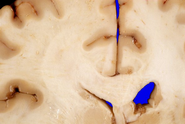 4A7 Gliomatosis cerebri, focal GBM (Case 4) 1