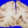 4A8 Gliomatosis cerebri, focal GBM (Case 4) 10