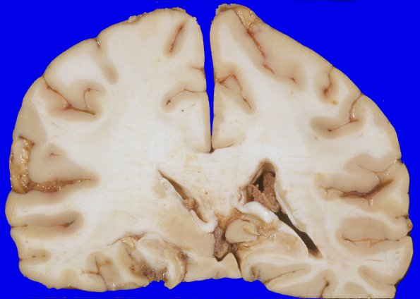 4A8 Gliomatosis cerebri, focal GBM (Case 4) 10