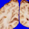 4A9 Gliomatosis cerebri, focal GBM (Case 4) 2