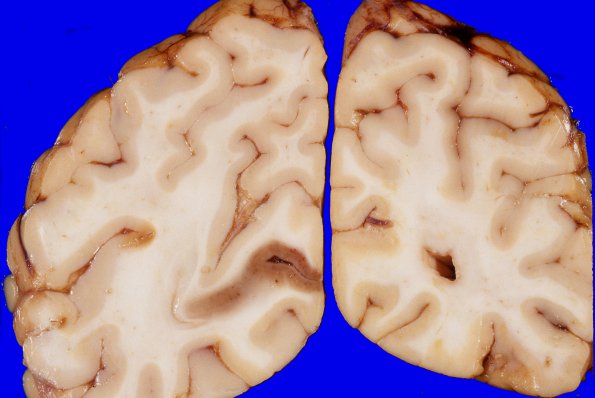 4A9 Gliomatosis cerebri, focal GBM (Case 4) 2