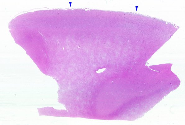 4B1 Gliomatosis cerebri, focal GBM (Case 4) N13 WM H&E 1