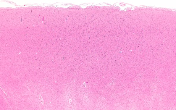 4B2 Gliomatosis cerebri, (Case 4) N13 2X