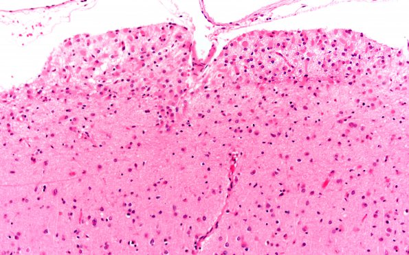 4B3 Gliomatosis cerebri, (Case 4) N13 20X 2