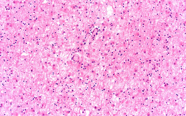 4B4 Gliomatosis cerebri, (Case 4) N13 20X 4