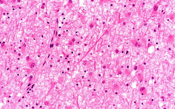 4B5 Gliomatosis cerebri, (Case 4) N13 40X 2