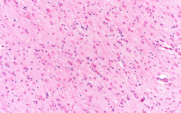 4B6 Gliomatosis cerebri, (Case 4) N13 10X 5