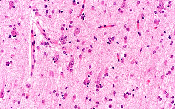 4B7 Gliomatosis cerebri (Case 4) N13 40X 3A