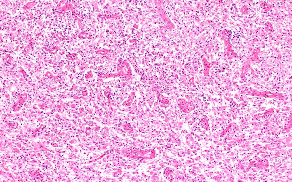 4B8 Gliomatosis cerebri, GBM (Case 4) N11 10X 3B